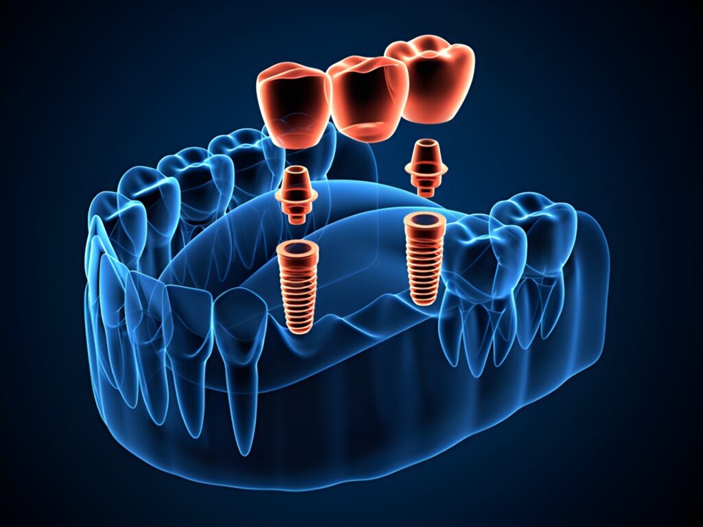 implant supported bridges near you