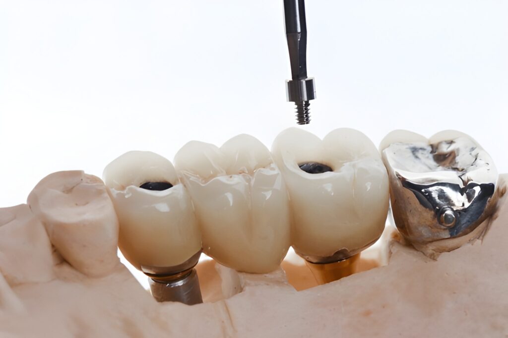 implant-supported dentures near you
