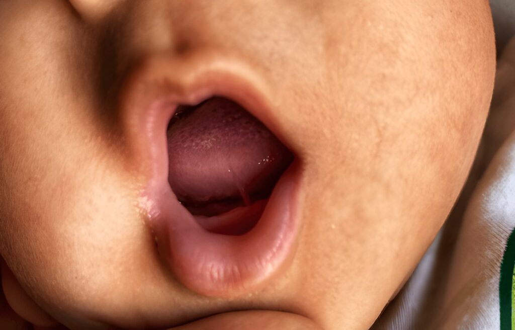 lip ties near you