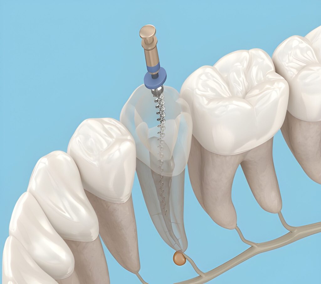 root canal treatment near you