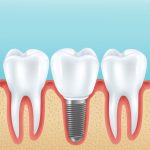 how dental bridges restore function and fill the gap of missing teeth