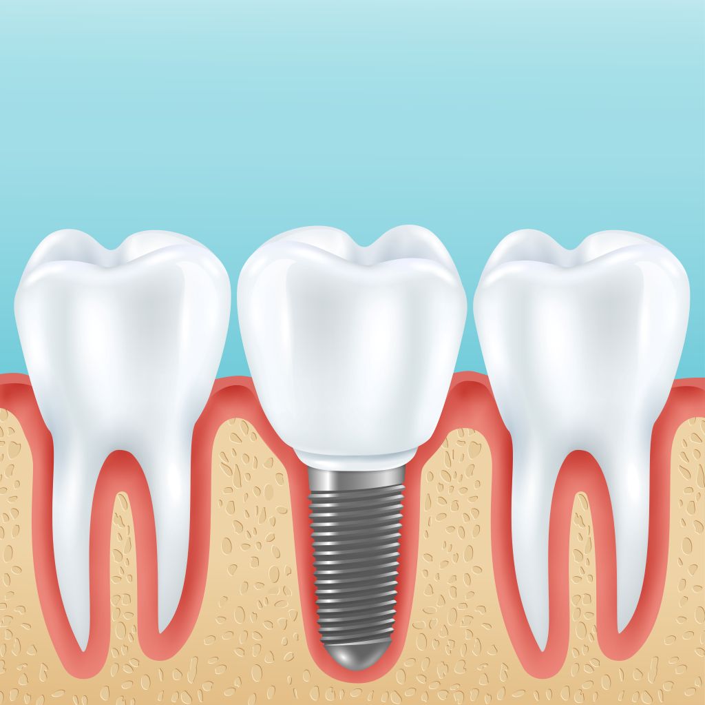 how dental bridges restore function and fill the gap of missing teeth