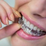benefits of invisalign over traditional braces