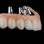 dental bridge treatment
