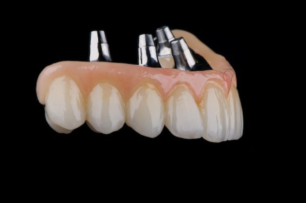 dental bridge treatment